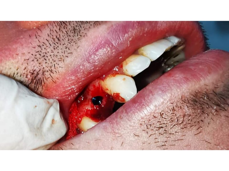 Implant