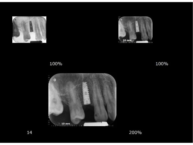 Implant