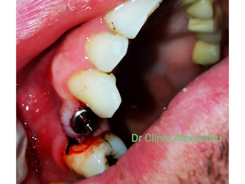 Implant