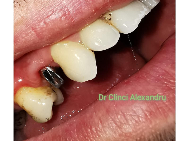 Implant
