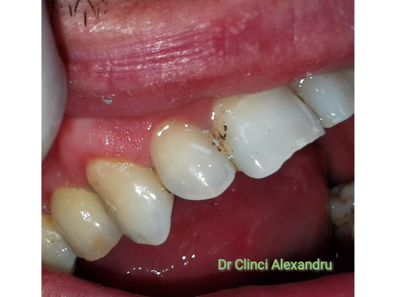 Implant