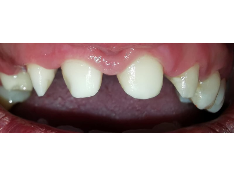 Zirconiu