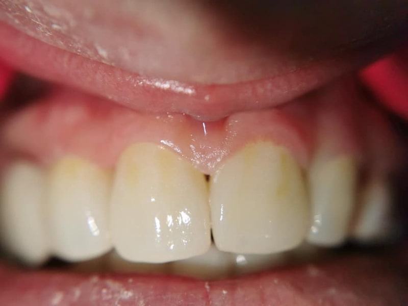 Zirconiu