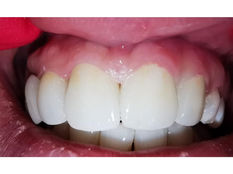 Zirconiu
