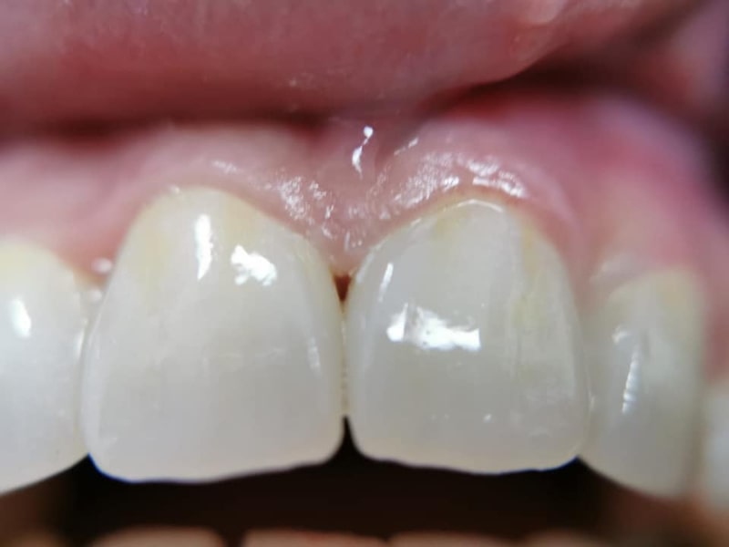Zirconiu